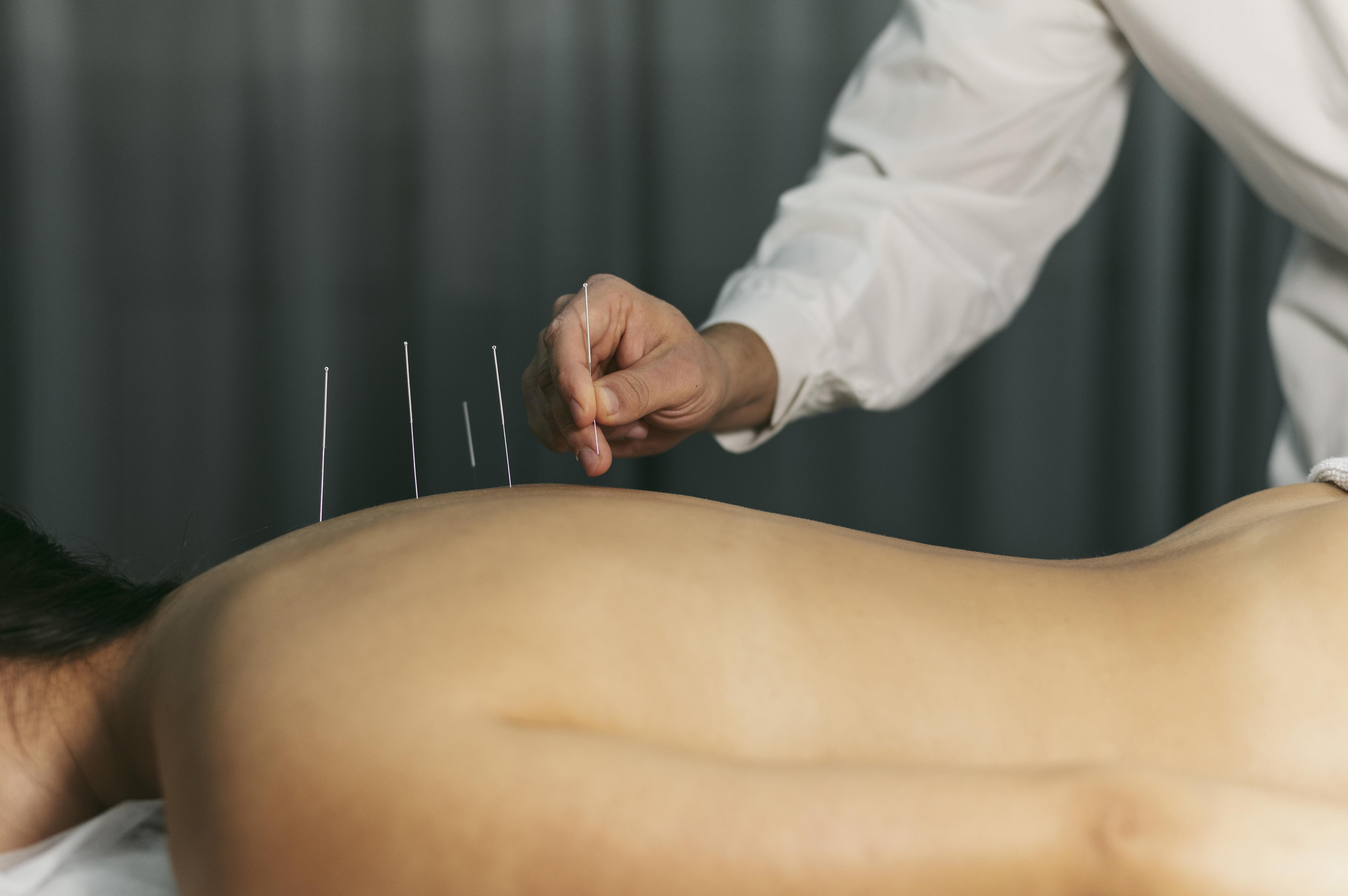 acupuncture-process (1).jpg